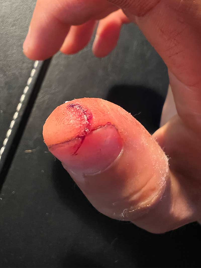 Thumb Injury NSFW v2